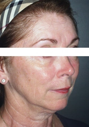 Face Lift – Case 1 2024