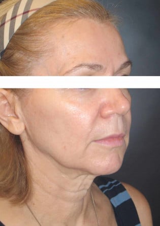 Face Lift – Case 2 2024