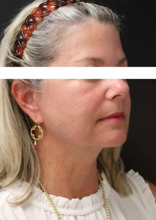 Face Lift – Case 3 2024