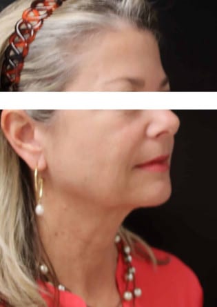 Face Lift – Case 3 2024