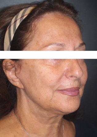 Face Lift – Case 5 2024