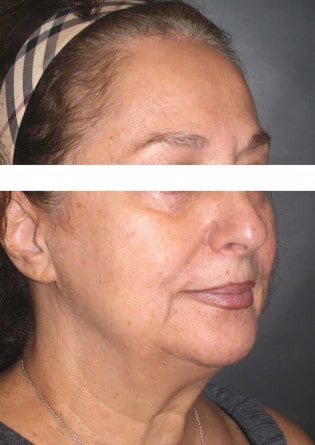 Face Lift – Case 5 2024