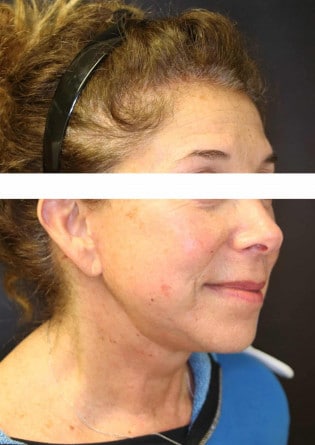 Face Lift – Case 6 2024