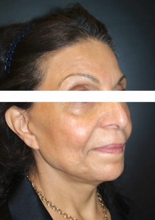 Face Lift – Case 7 2024