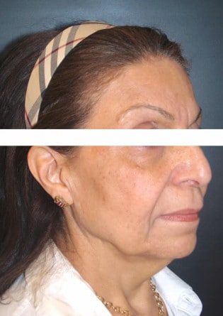 Face Lift – Case 7 2024