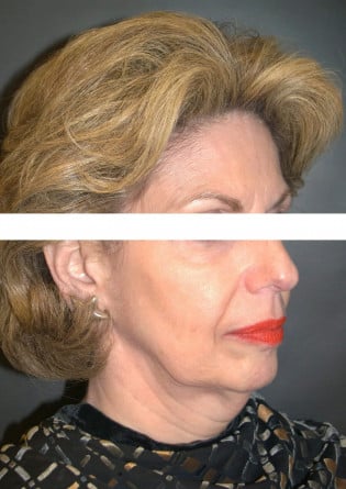 Face Lift – Case 8 2024