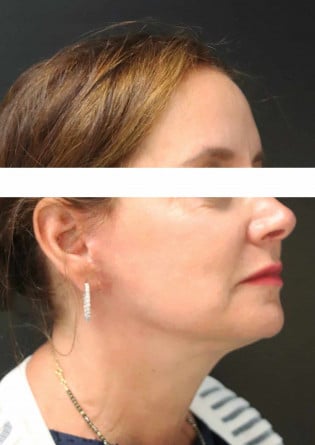 Face Lift – Case 9 2024