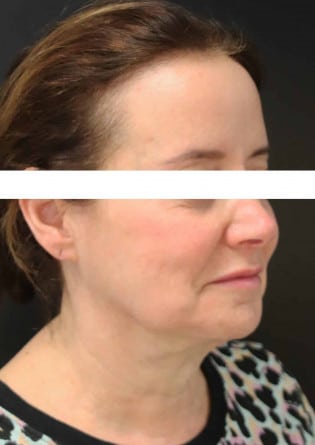 Face Lift – Case 9 2024