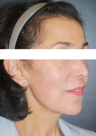 Face Lift – Case 10 2024