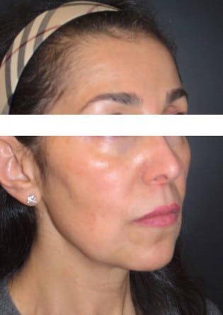 Face Lift – Case 10 2024