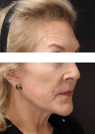 Face Lift – Case 11 2024