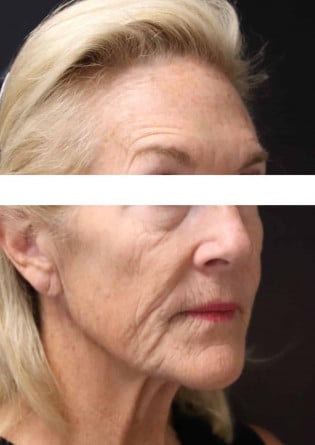 Face Lift – Case 11 2024